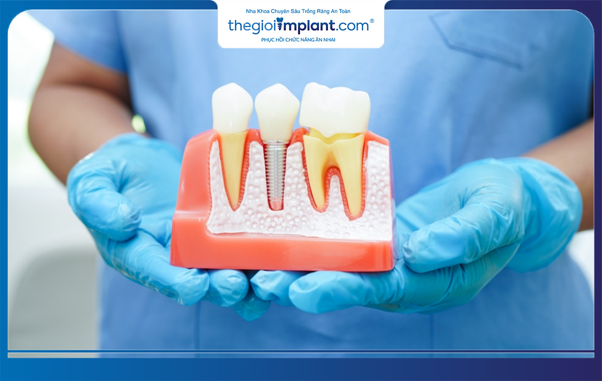 Răng implant có tuổi thọ cao nhờ cấu tạo vững chắc và được làm từ chất liệu Titanium cao cấp