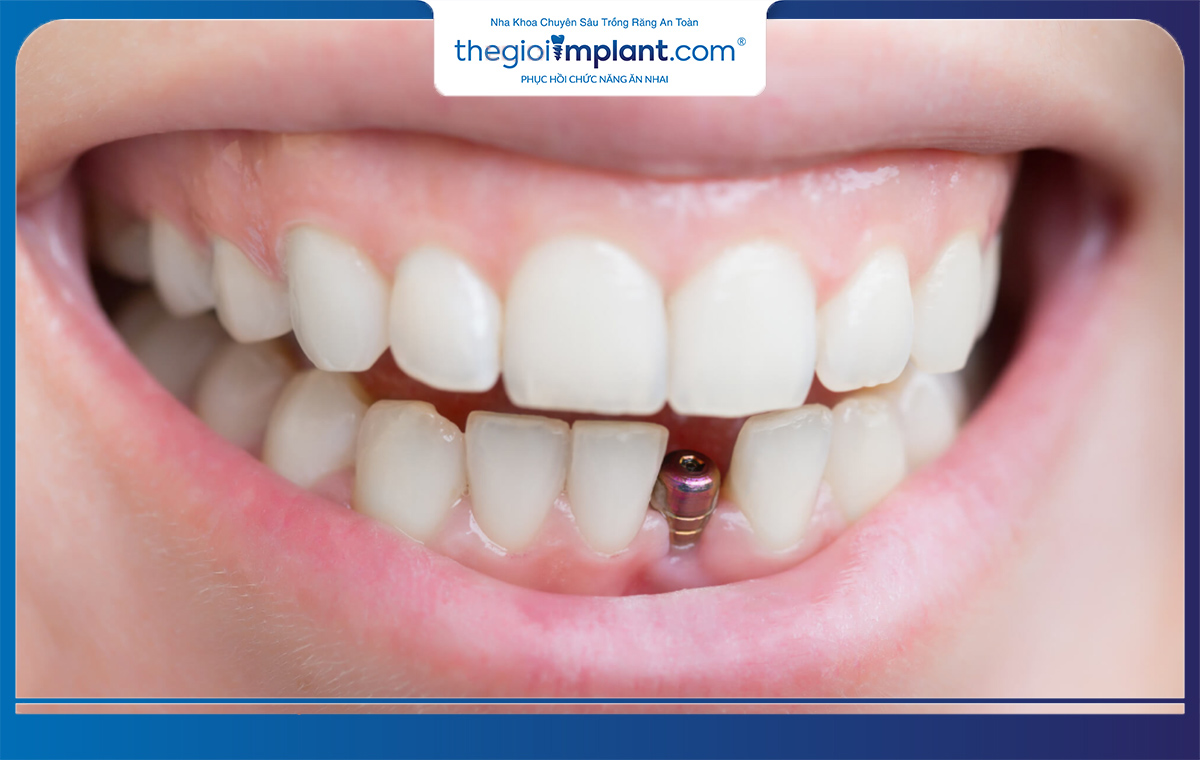 Có rất nhiều yếu tố ảnh hưởng tới tuổi thọ của răng implant