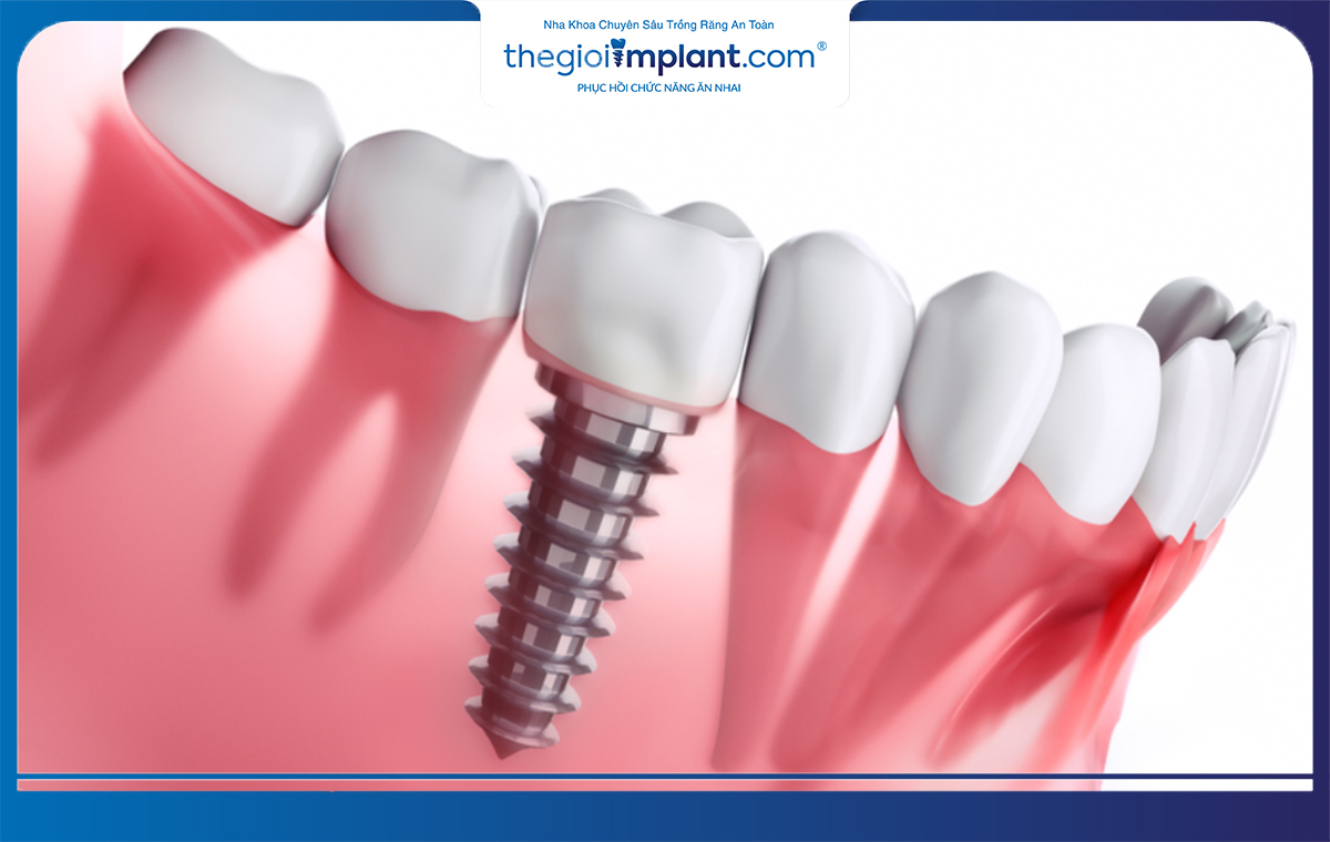 Lựa chọn implant có khả năng chịu lực tốt giúp ăn nhai thuận lợi