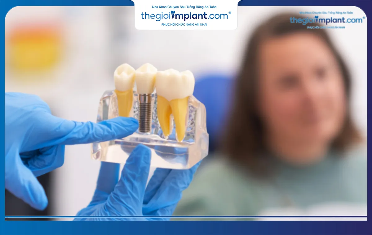 Sử dụng trụ implant Straumann mang lại nhiều lợi ích cho sức khỏe bệnh nhân
