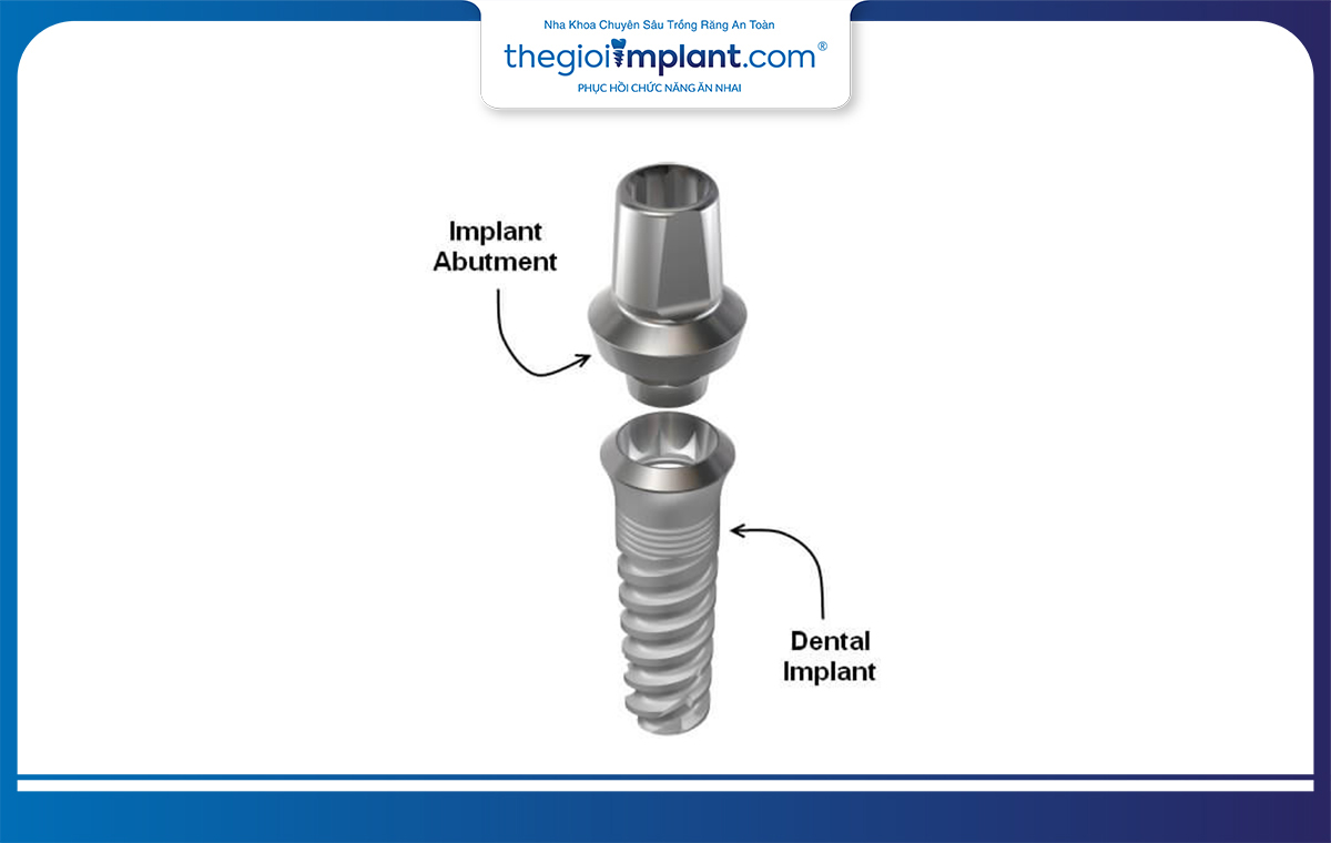 Abutment implant giúp gắn kết trụ và xương hàm