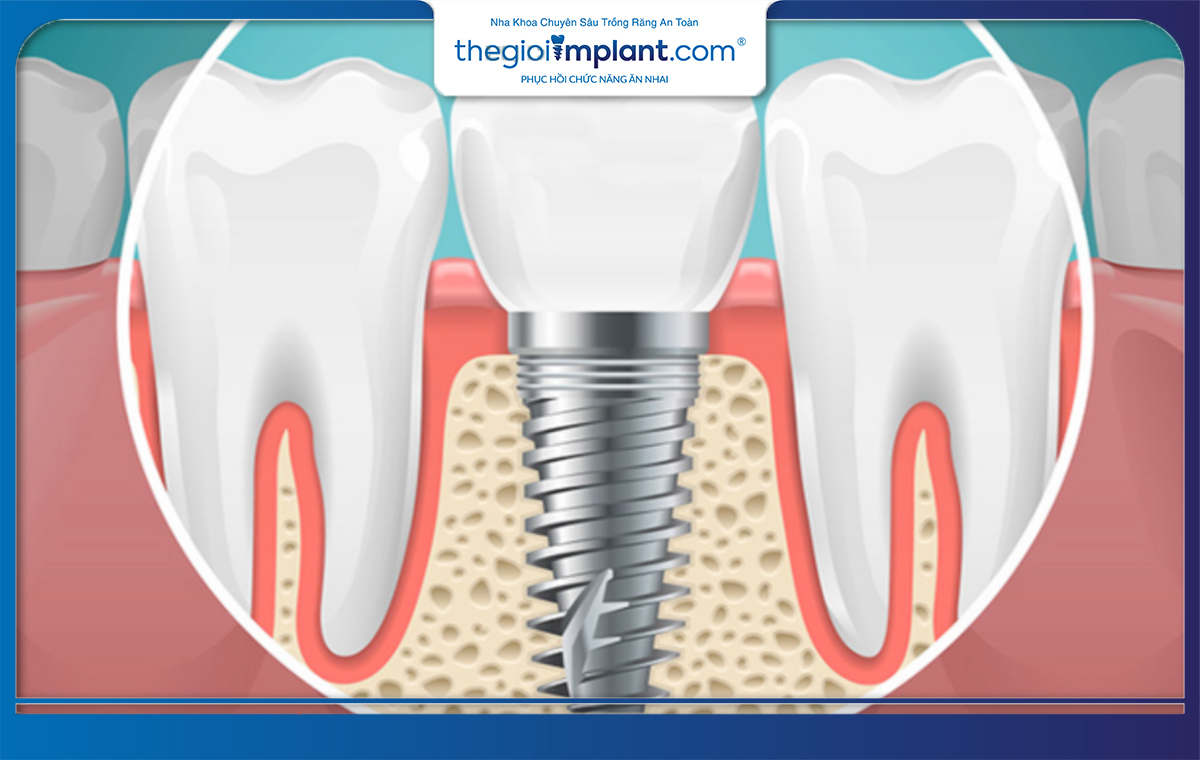 Tùy vào trình trạng xương mà người bệnh sẽ được chỉ định ghép xương răng