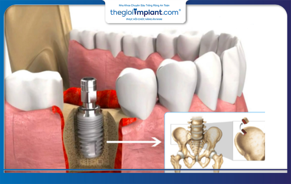 Bác sĩ có thể lấy một mảnh xương từ những vùng khác để ghép xương răng