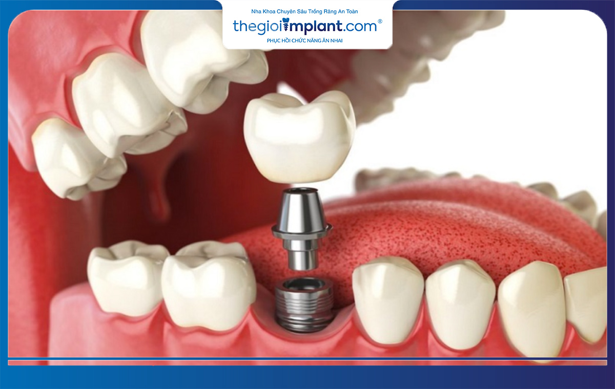 Trụ Implant Dentium được cấu tạo bởi 2 phần là trụ Implant và khớp nối 