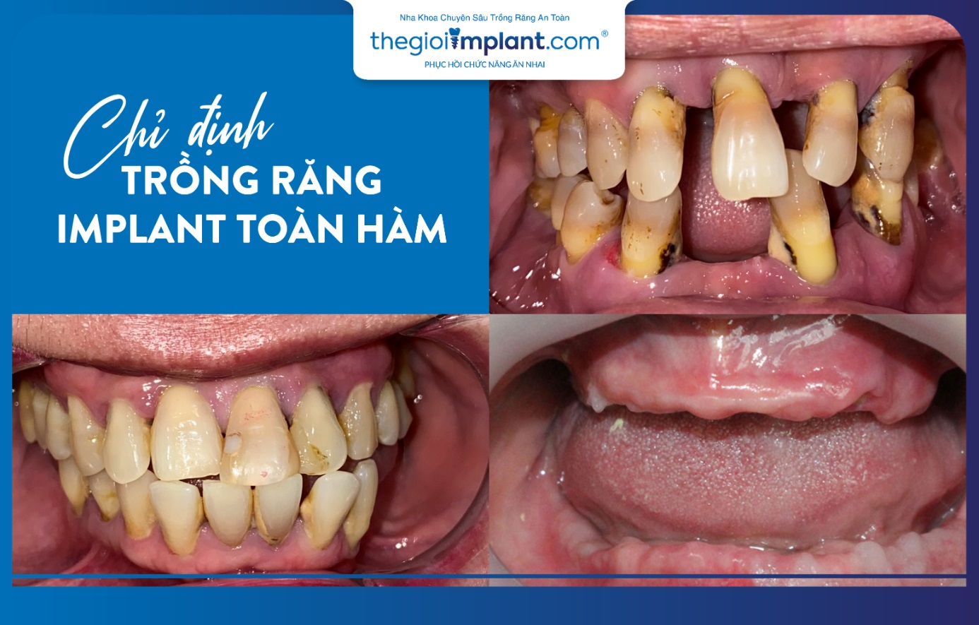 Chi phí trồng Implant Hàn Quốc phù hợp với nhiều đối tượng khách hàng 