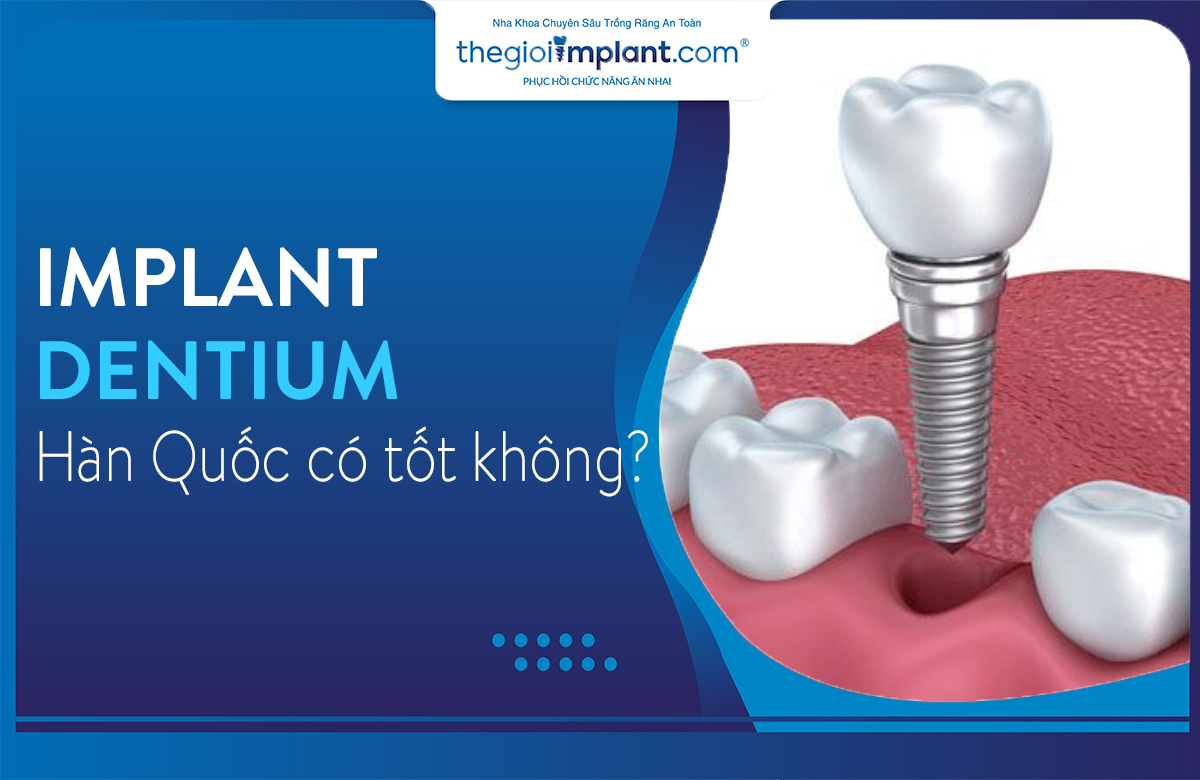 Trụ Implant Dentium chắc chắn, ổn định và giá thành hợp lý