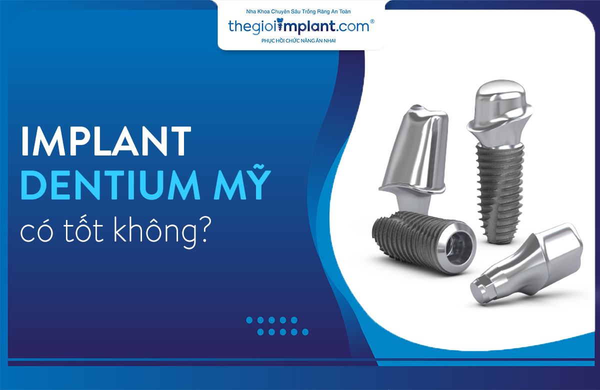 implant dentium mỹ thumbnail