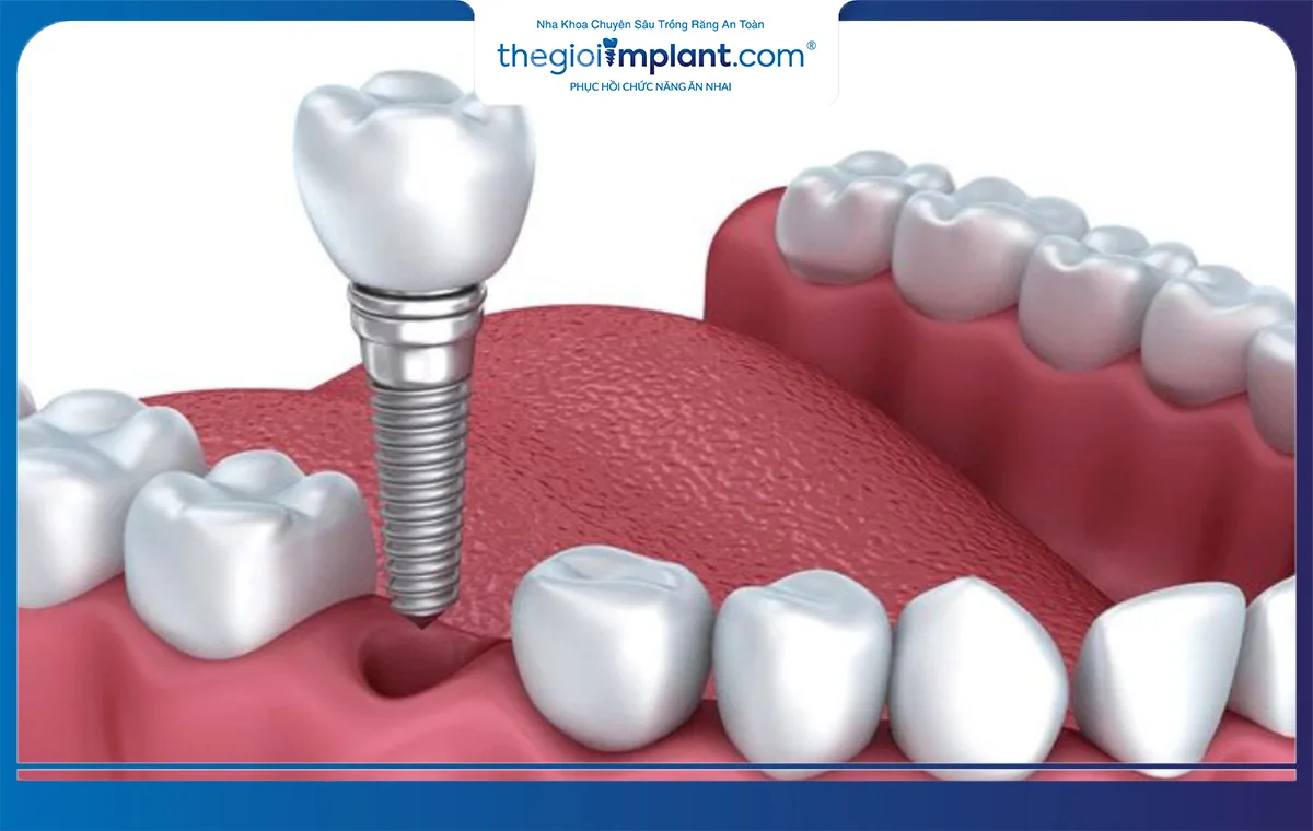 Bác sĩ khuyến cáo nên cấy ghép implant Hiossen càng sớm càng tốt sau khi mất răng
