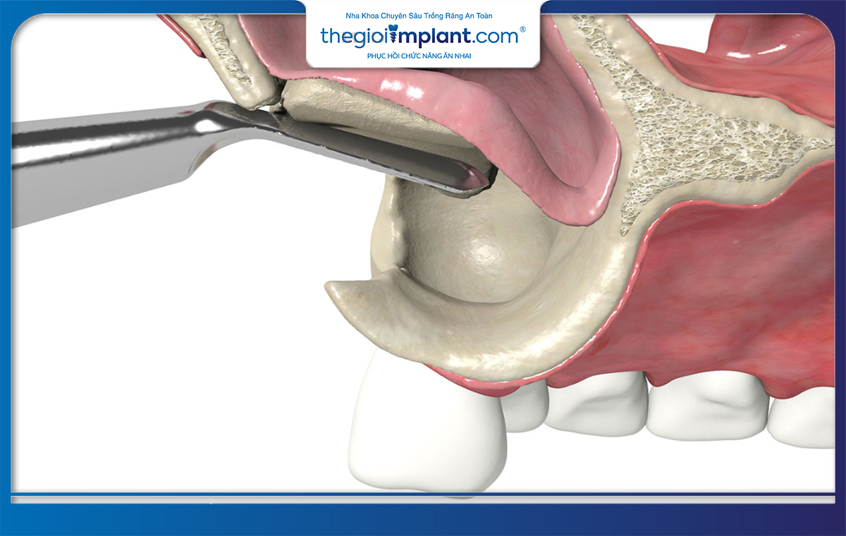 Nâng xoang giúp làm tăng thể tích xương và đủ điều kiện về chiều cao để thực hiện trồng răng implant