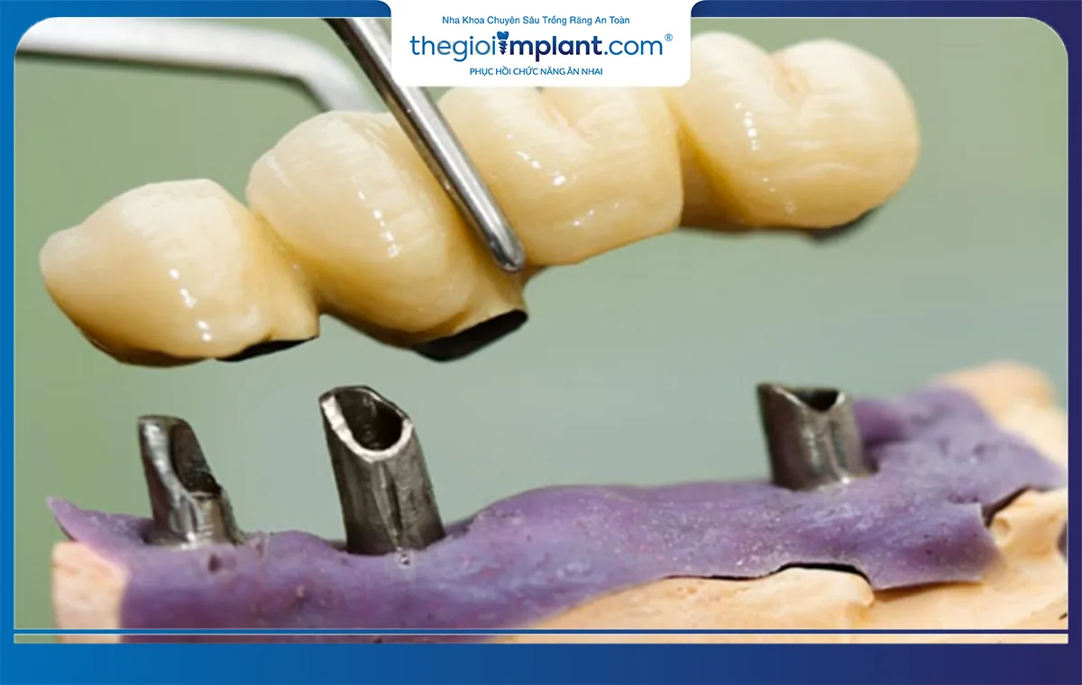 Trụ implant bị đào thải