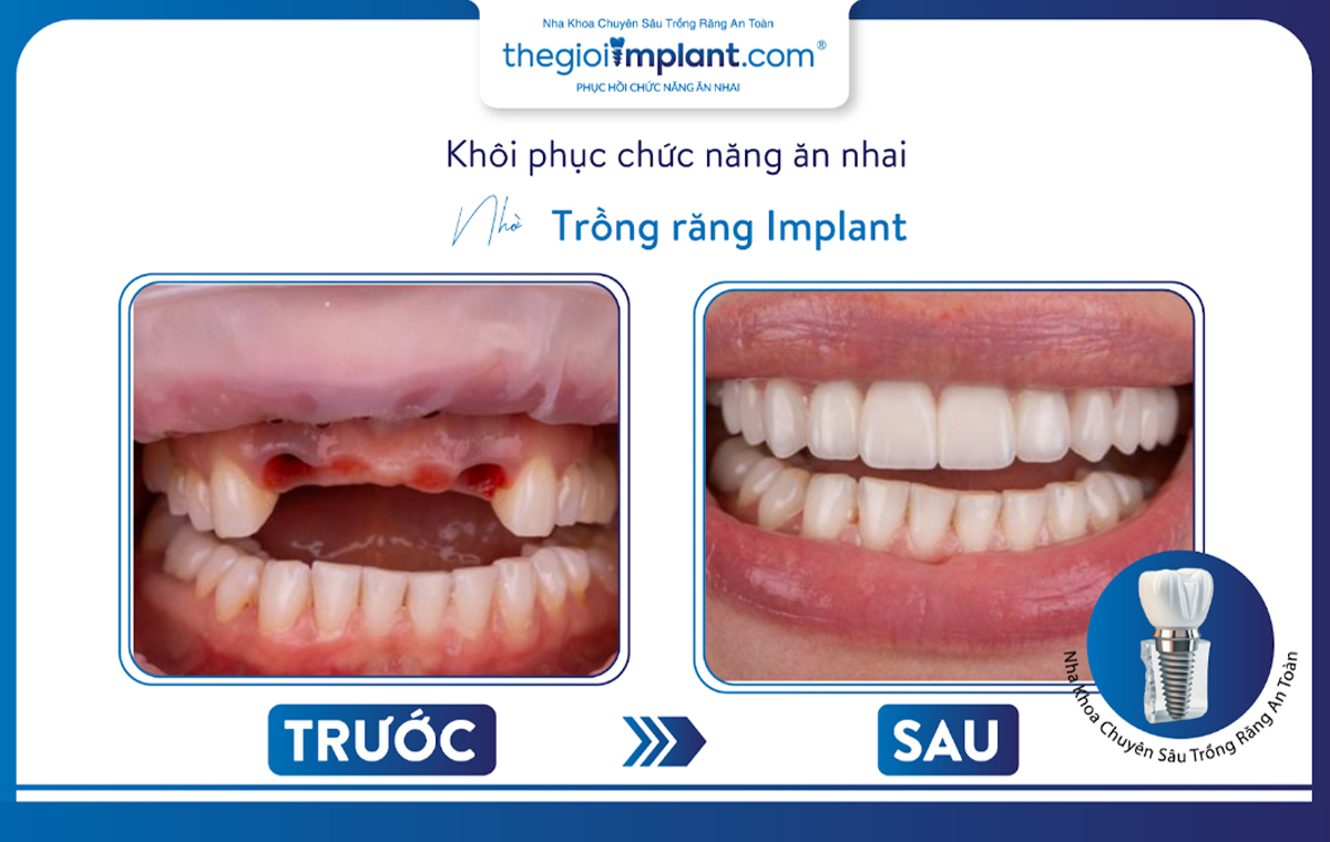 Một trong những ca cấy ghép implant khó được thực hiện tại trung tâm