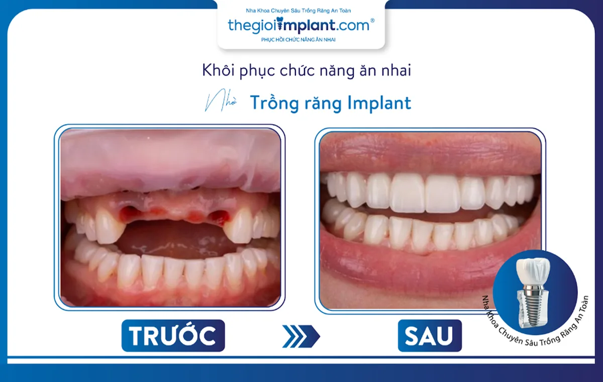 Một trong những ca cấy ghép implant khó được thực hiện tại trung tâm