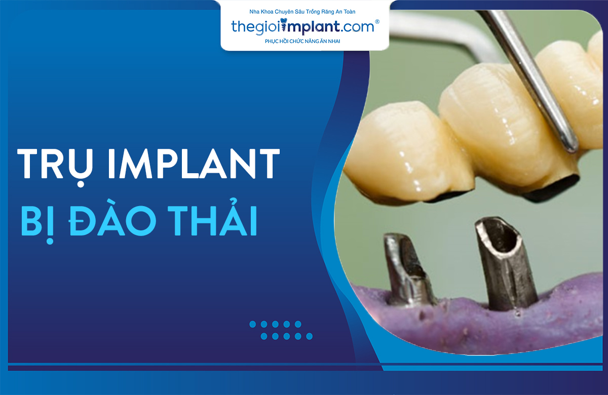 trụ implant bị đào thải thumbnail