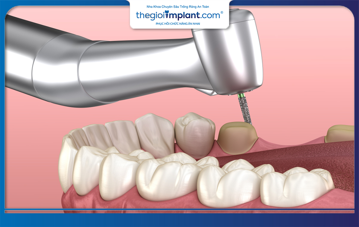 Bạn cần phải mài ít nhất 2 chiếc răng bên cạnh để làm trụ cầu