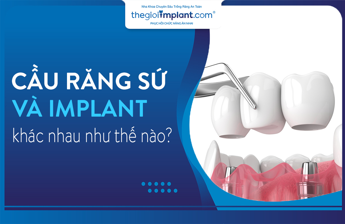 cầu răng sứ và implant