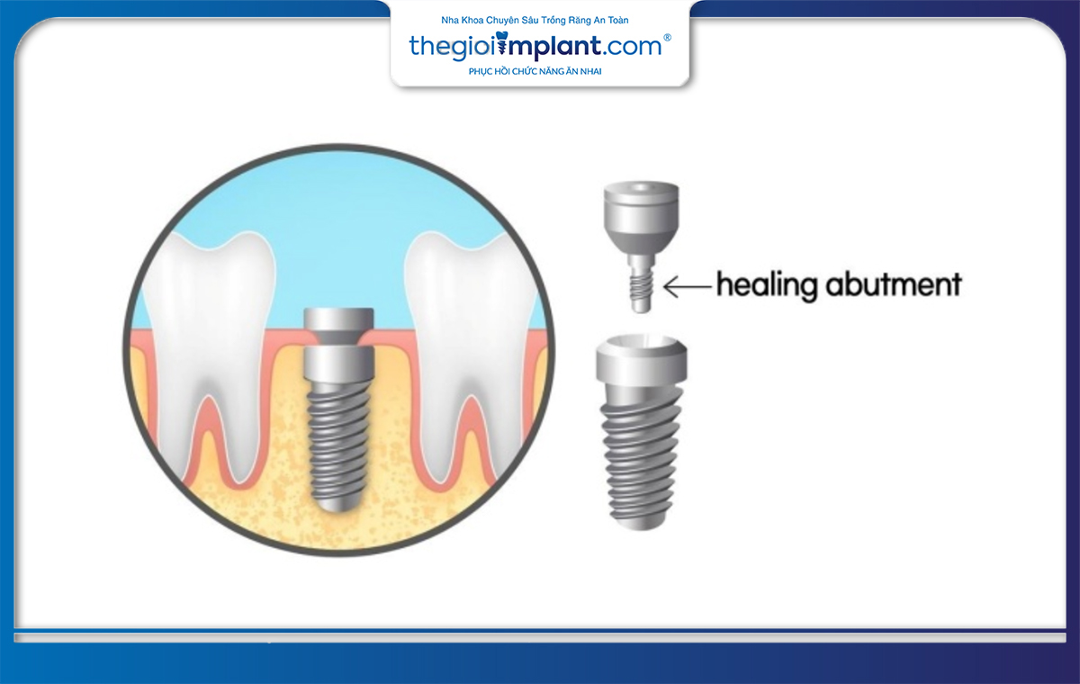 Healing là một bộ phận quan trọng và rất cần thiết trong cấy ghép implant 