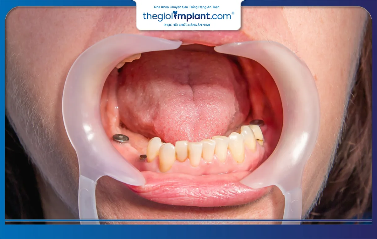 Healing giúp đảm bảo sự ổn định của trụ implant trước khi lắp mão sứ
