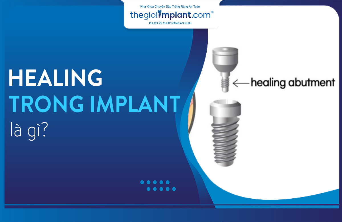 healing trong implant thumbnail