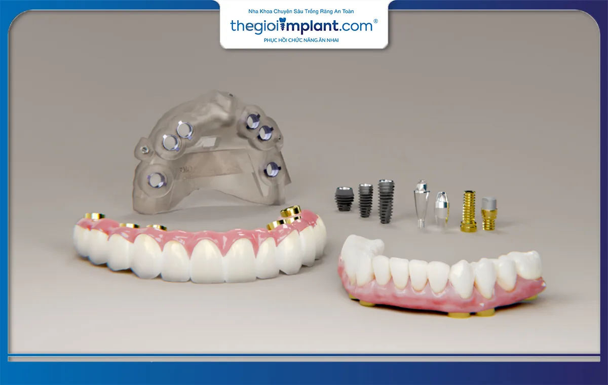 Trụ Dio implant là dòng sản phẩm nổi bật với nhiều ưu điểm vượt trội