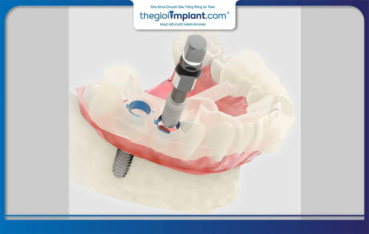 Vật liệu implant Dio được làm từ titanium, đã được chứng minh độ an toàn