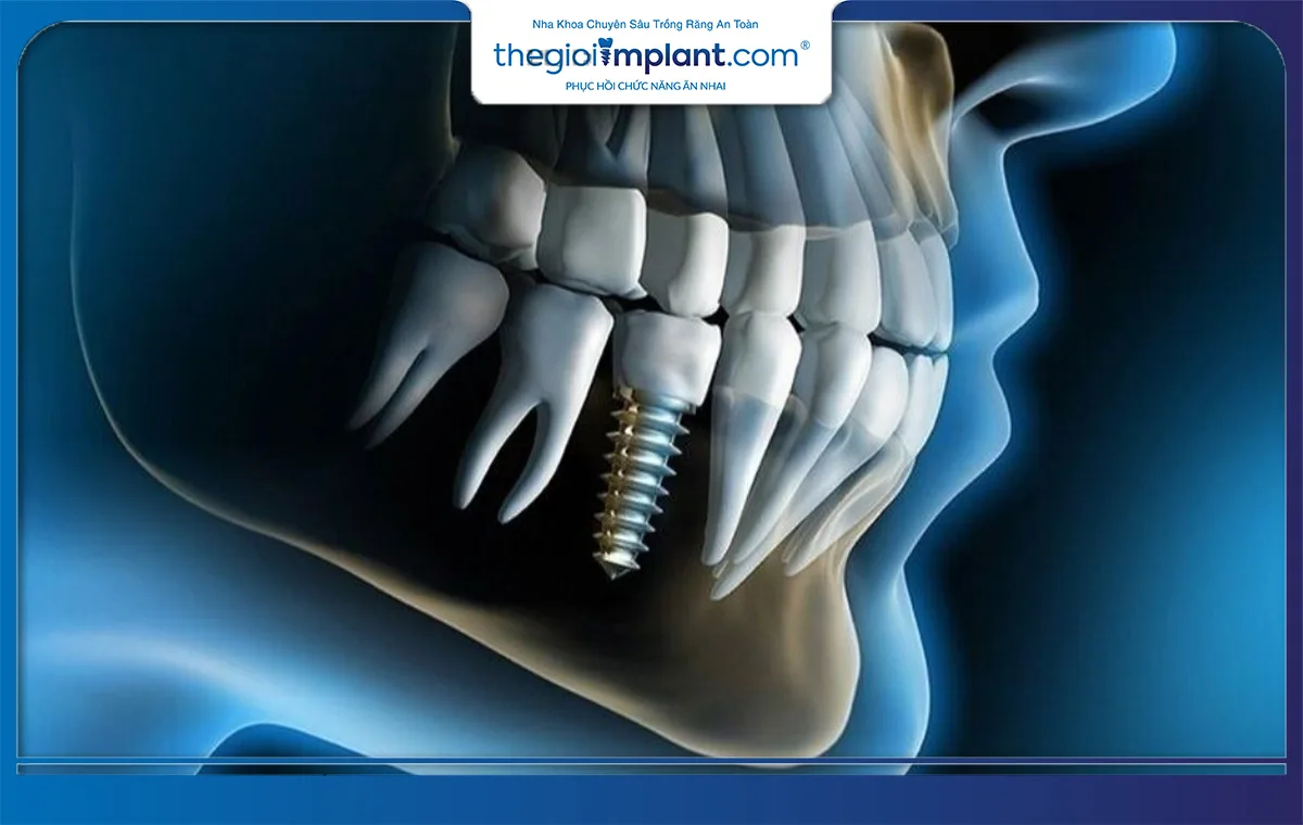 Trụ implant Dio Hàn Quốc sở hữu thiết kế thông minh, độ bền cao và chi phí thấp