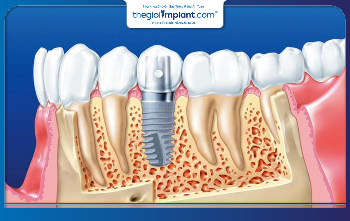 Mỗi cơ sở nha khoa sẽ có mức giá trồng trụ Dio khác nhau