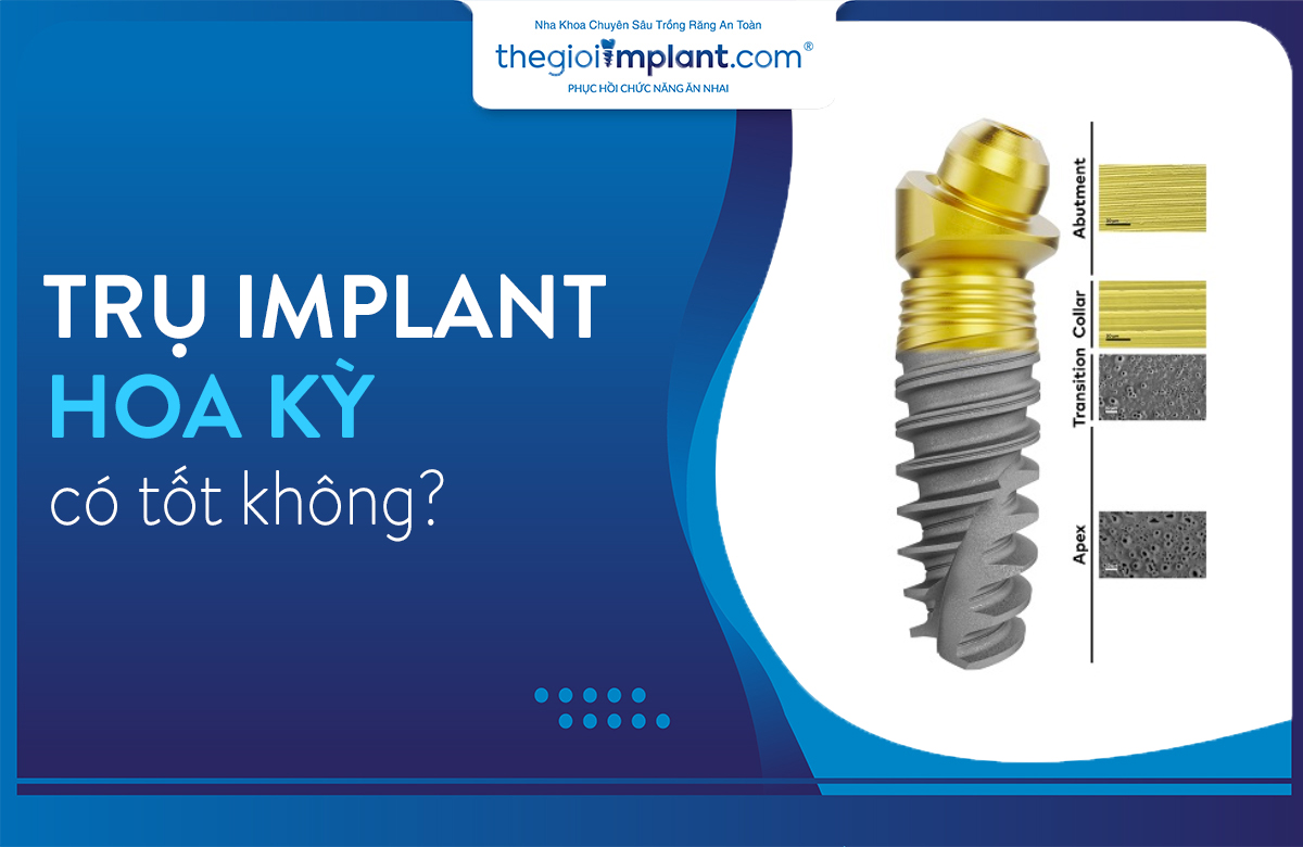 implant mỹ thumbnail