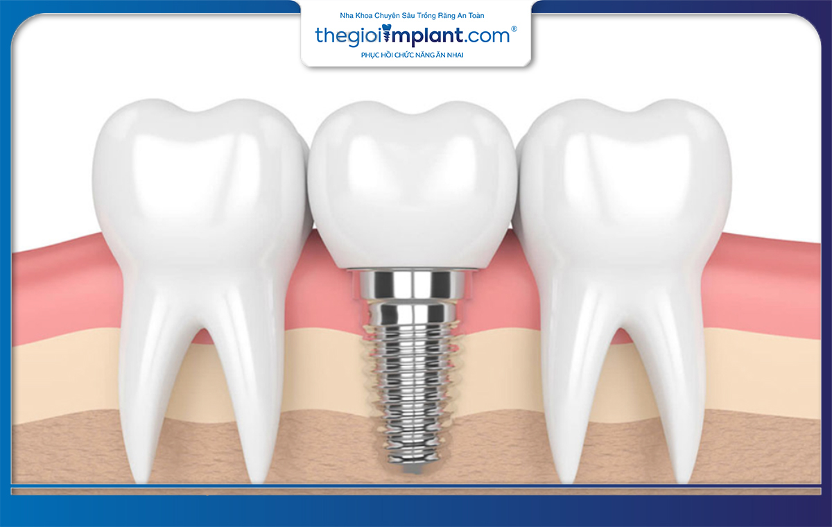 Trụ implant Nobel Biocare có độ tương thích cao