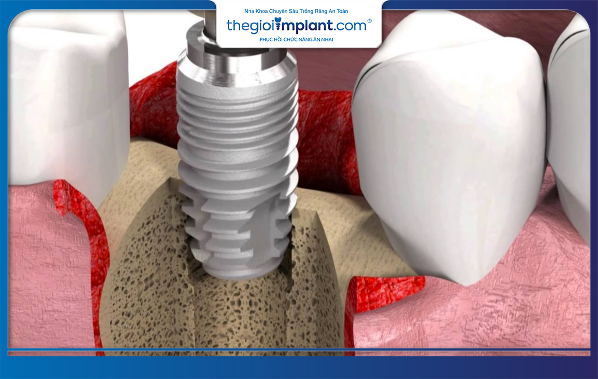 Nhờ thiết kế đặc biệt SIC Implant giúp bảo vệ an toàn cho cấu trúc xương hàm