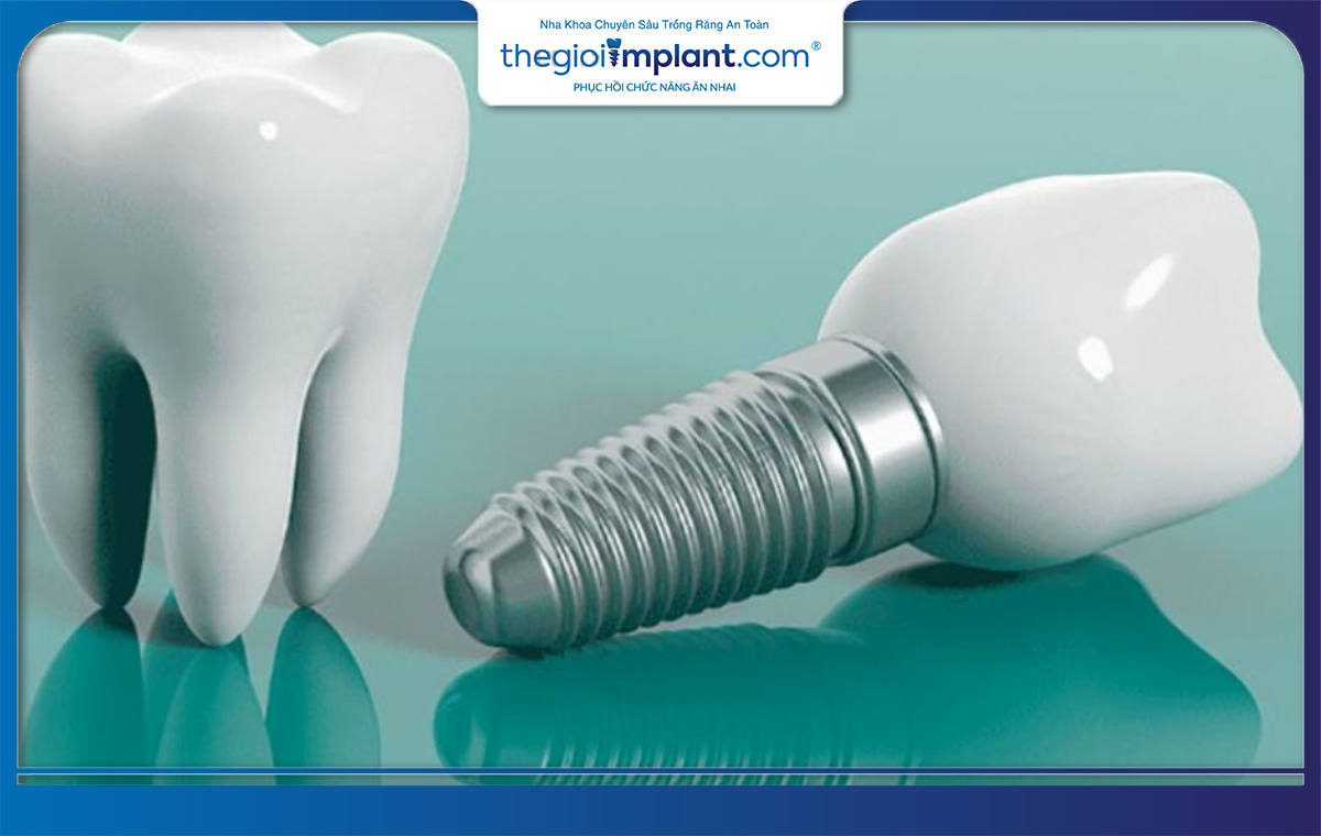 Bạn có thể sử dụng trụ implant SIC trong một khoảng thời gian rất dài