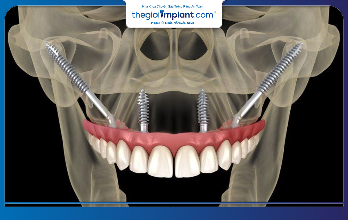 Cấy ghép implant xương gò má (Zygoma implants)