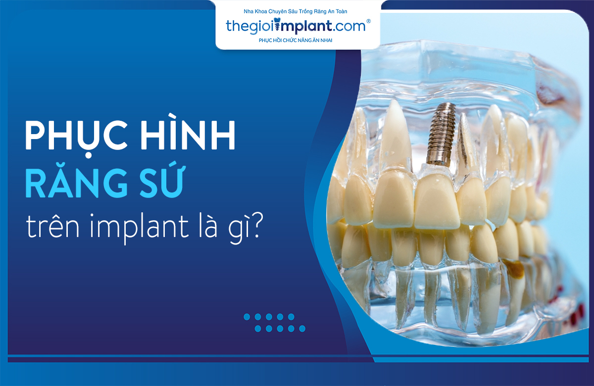 phục hình răng sứ trên implant thumbnail