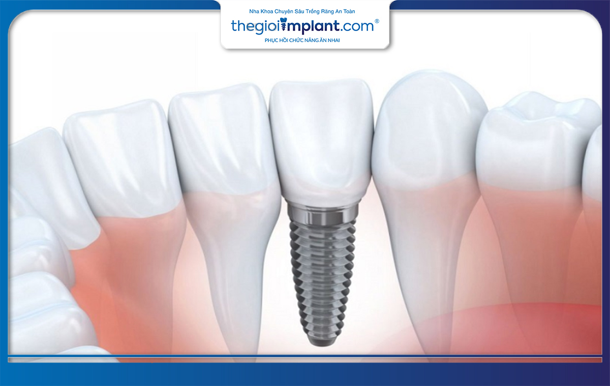 Trụ implant làm từ titanium nên không ảnh hưởng đến từ trường MRI