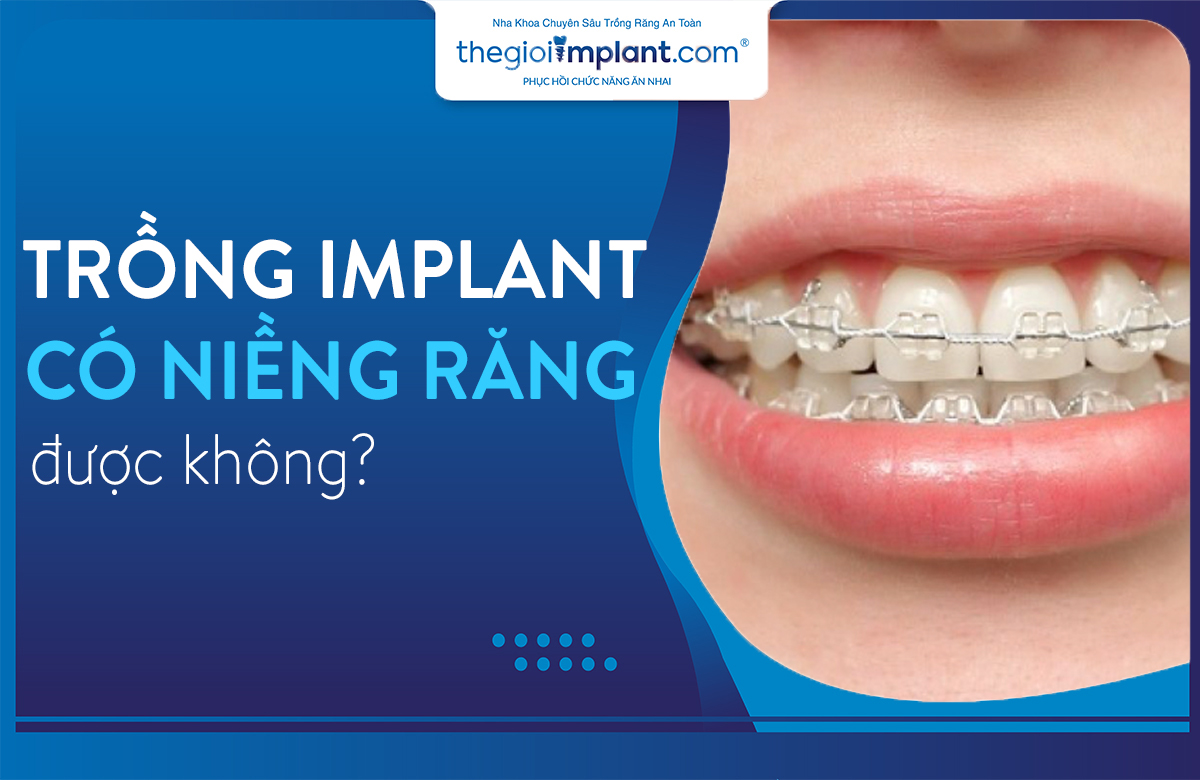 trồng răng implant có niềng răng được không thumbnail