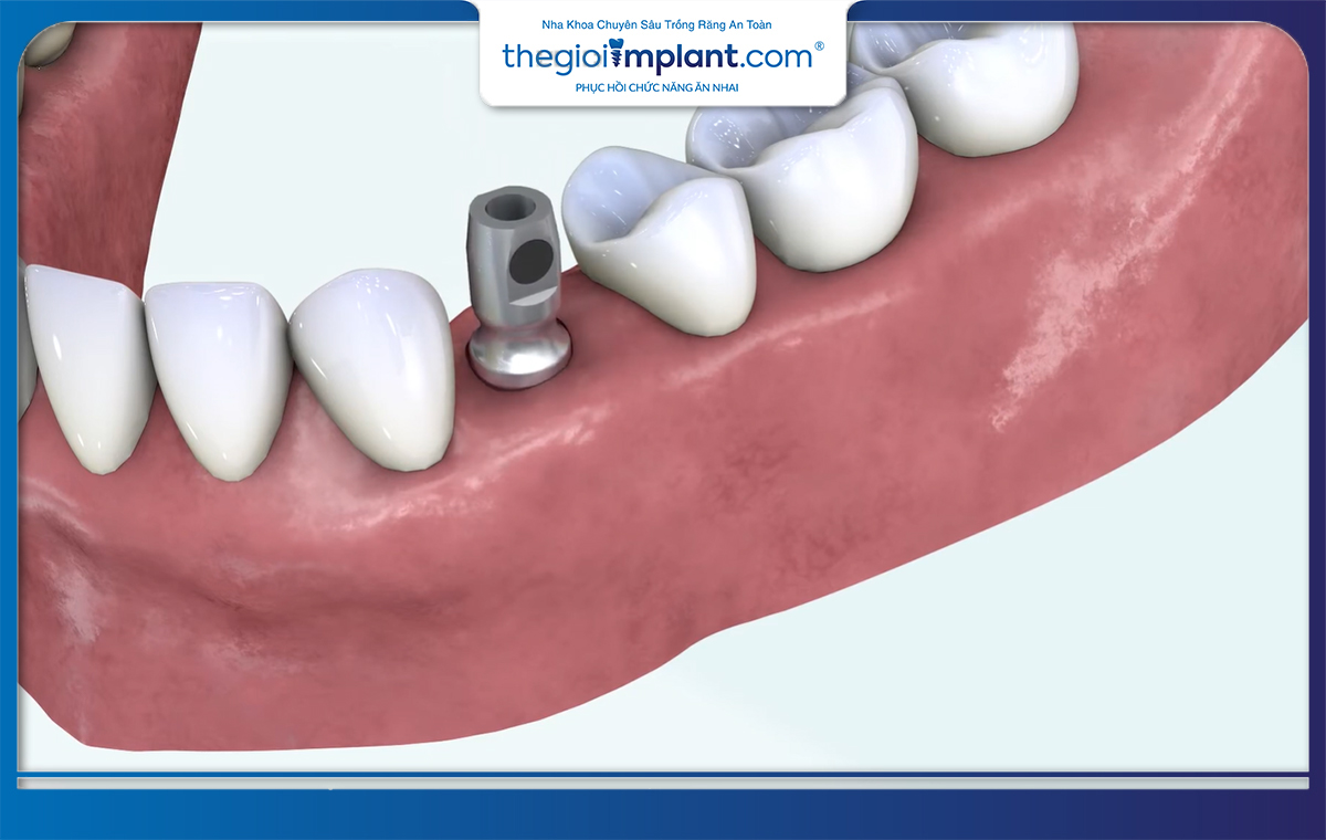 Trụ implant Kontact có ưu điểm dễ cấy ghép, tỷ lệ thành công cao