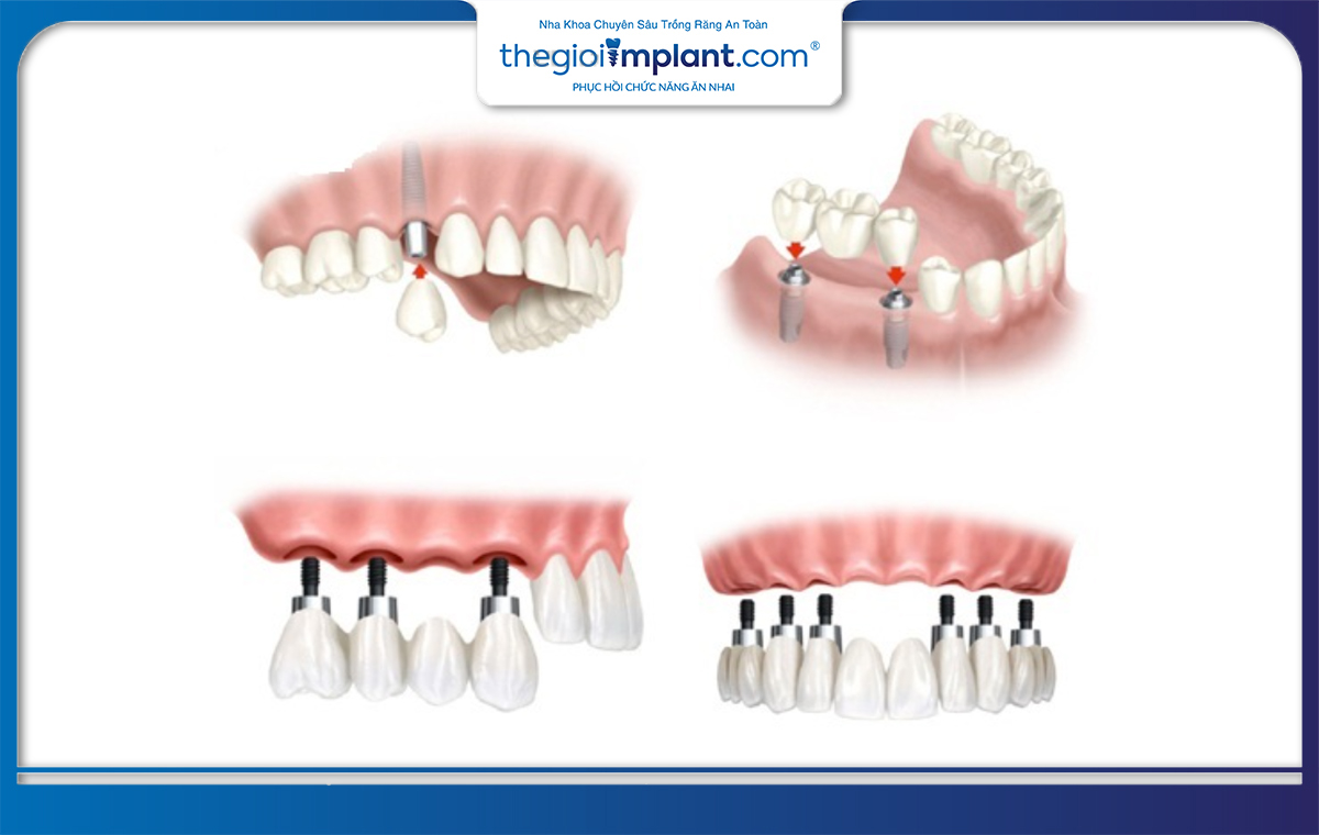 Trụ implant Kontact có thể được sử dụng trong nhiều trường hợp mất răng