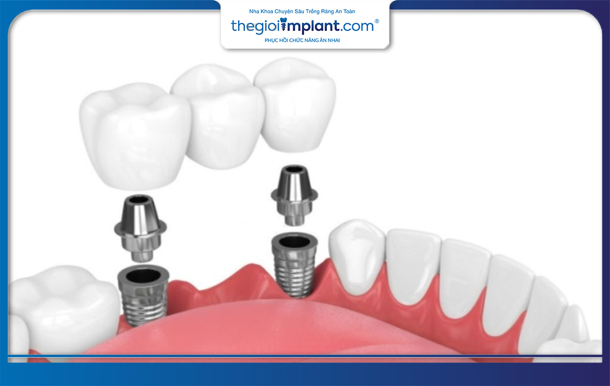 Thời gian cấy ghép trụ implant Kontact phụ thuộc vào từng tình trạng cụ thể