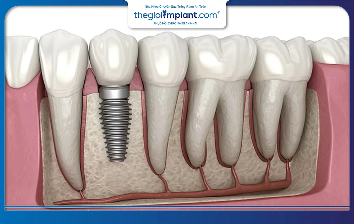 Trụ implant Mỹ có khả năng tích hợp xương tốt