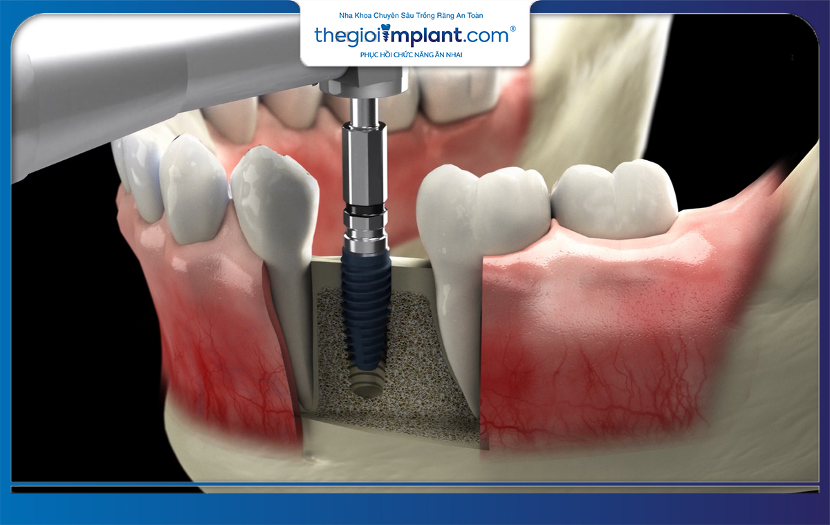 Trụ implant Megagen sau cấy sẽ bám sâu và đứng vững chắc trong xương hàm