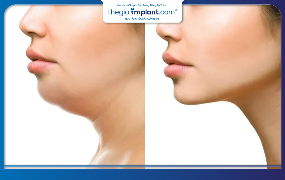 Tiêm filler để có đường jawline đẹp