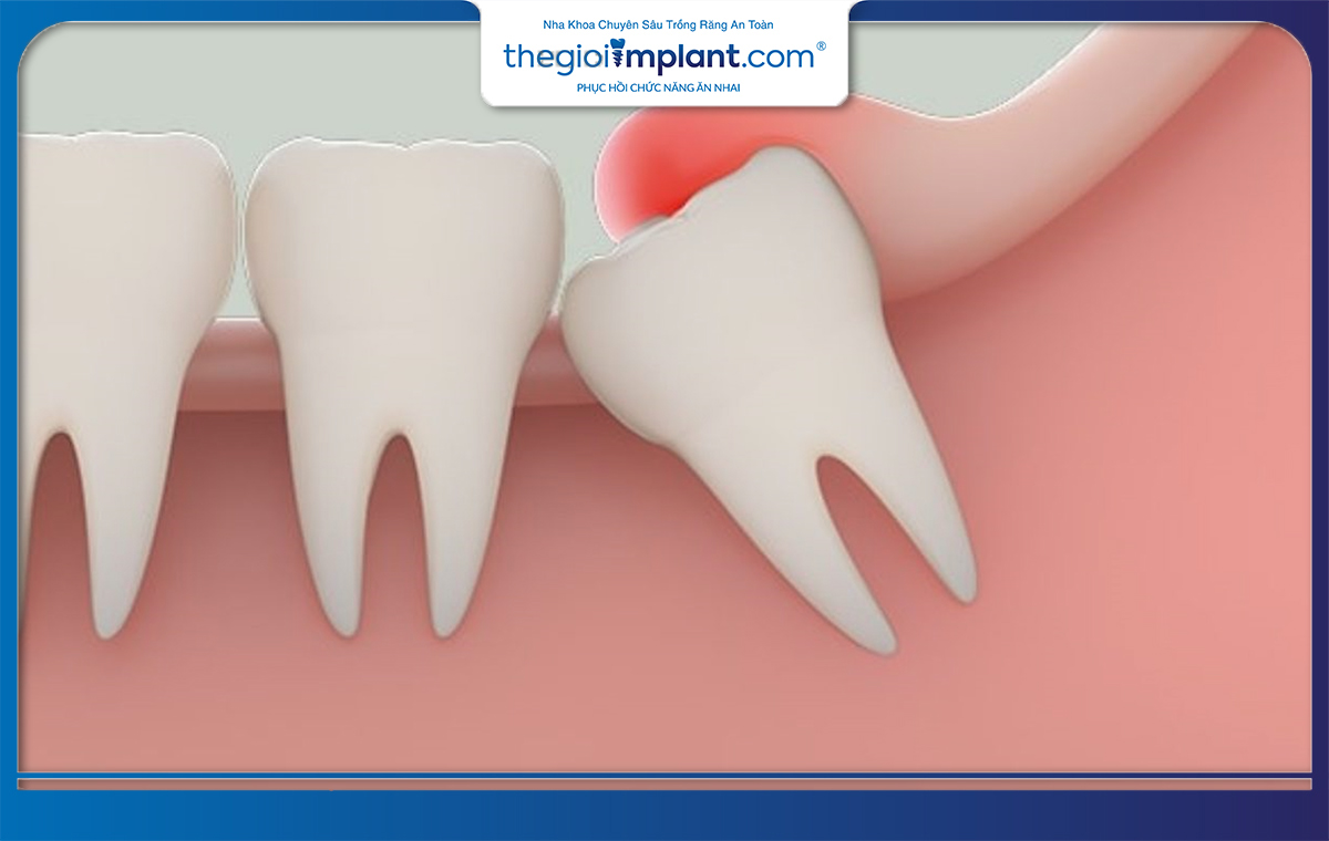 Mọc răng khôn bị sốt còn kèm theo tình trạng đau nhức