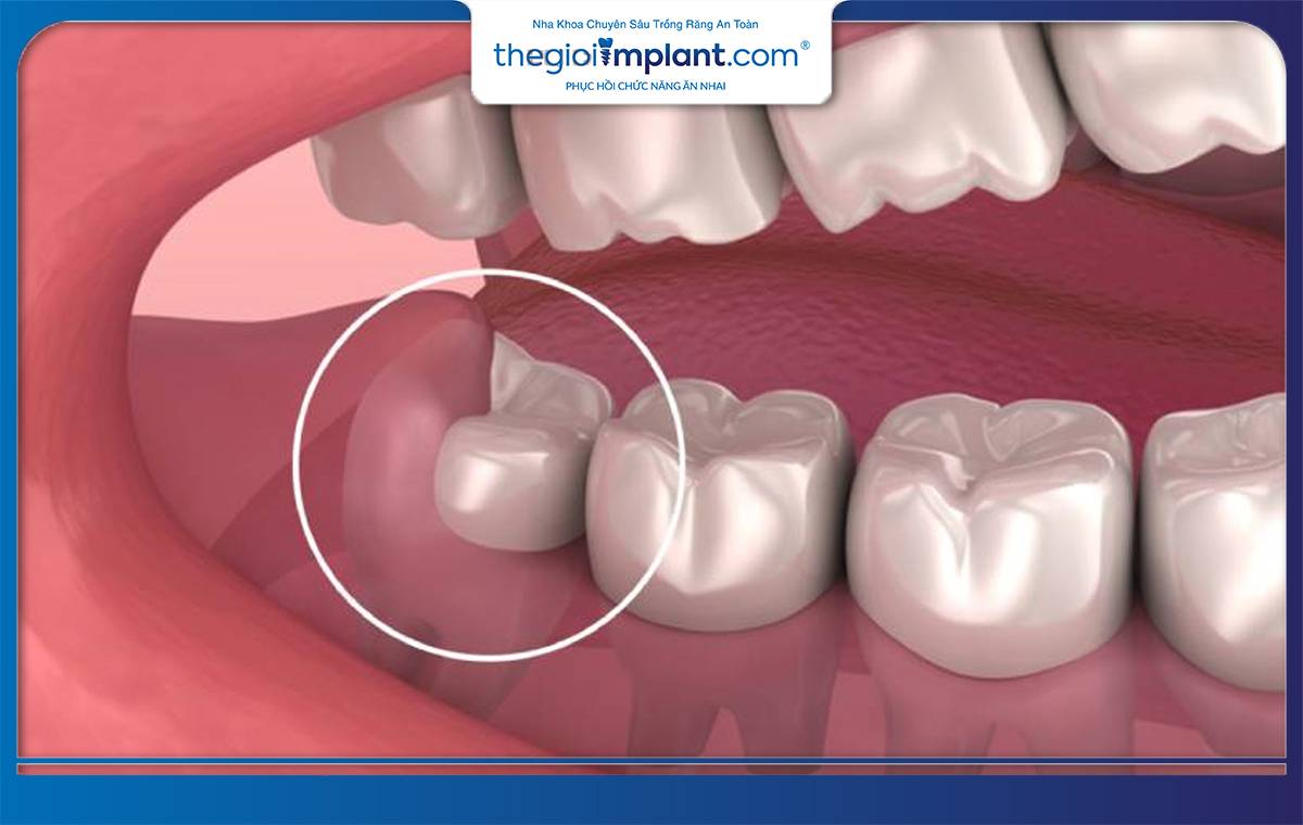 Răng khôn mọc thẳng, đúng vị trí