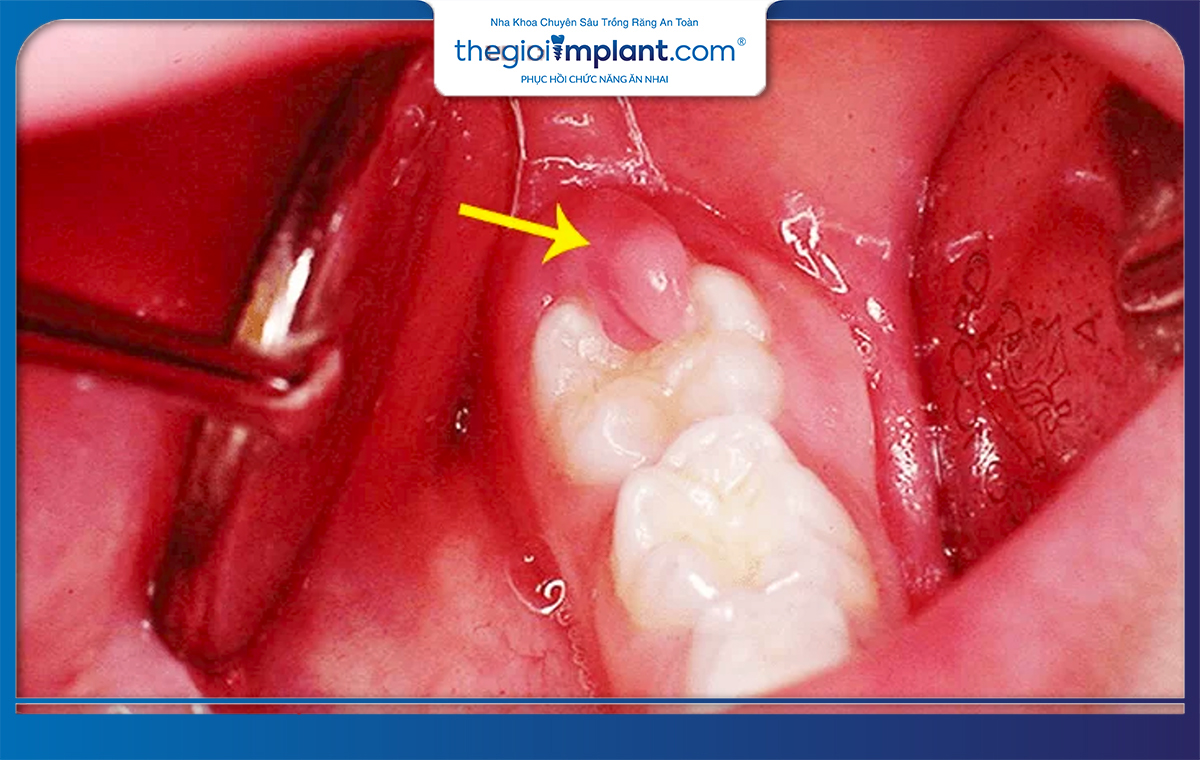 Nên điều trị tình trạng viêm nhiễm trước khi nhổ răng