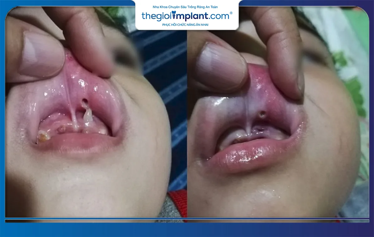 Răng mọc trên lợi có thể đâm vào môi gây đau đớn