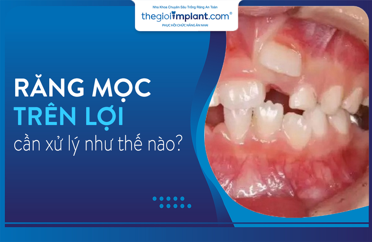 răng mọc trên lợi thumbnail