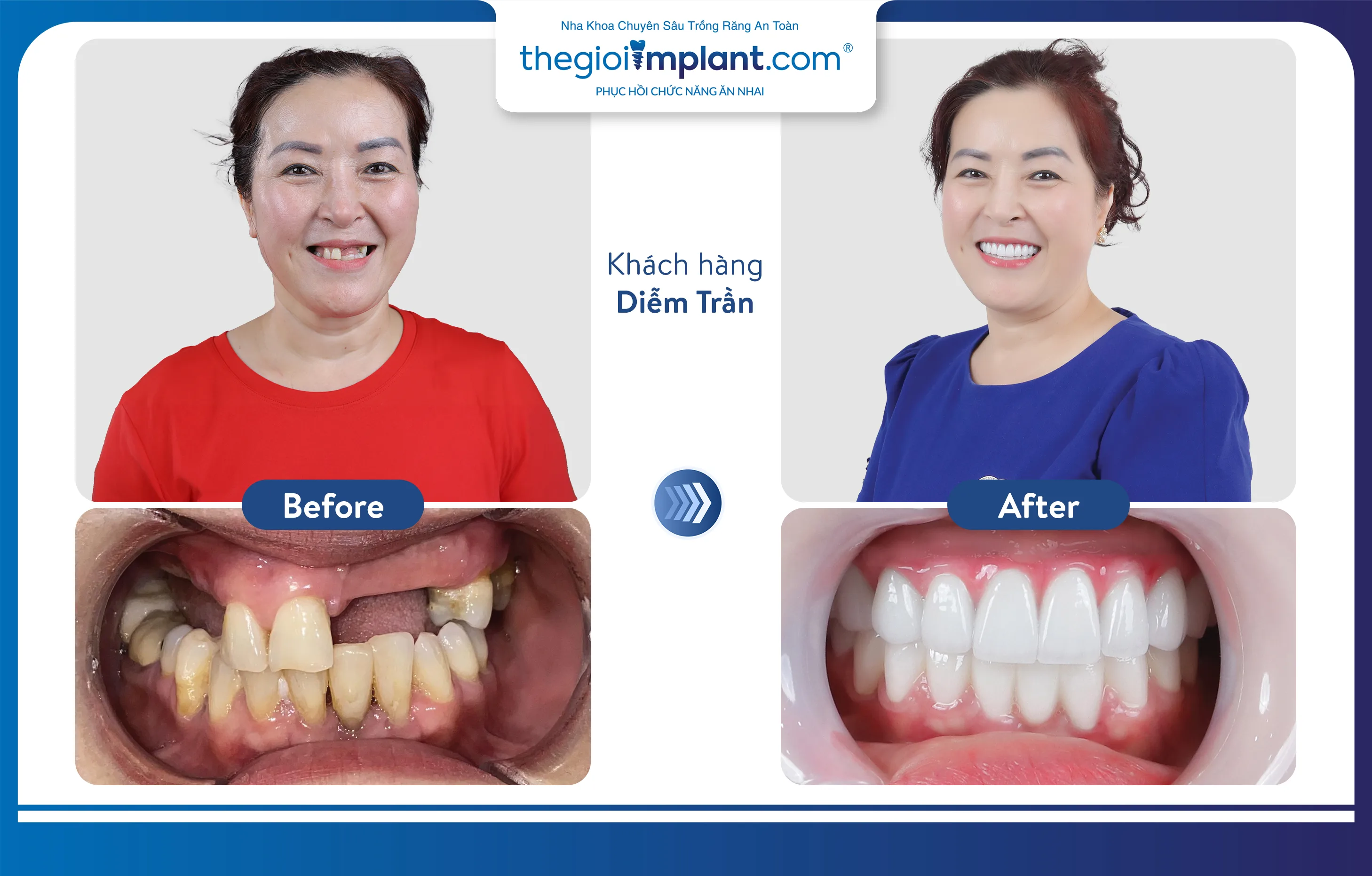 VTV1 ĐƯA TIN: NHA KHOA THẾ GIỚI IMPLANT.COM TRỒNG RĂNG AN TOÀN, BỀN VỮNG VỚI MÁNG ĐỊNH VỊ DSG