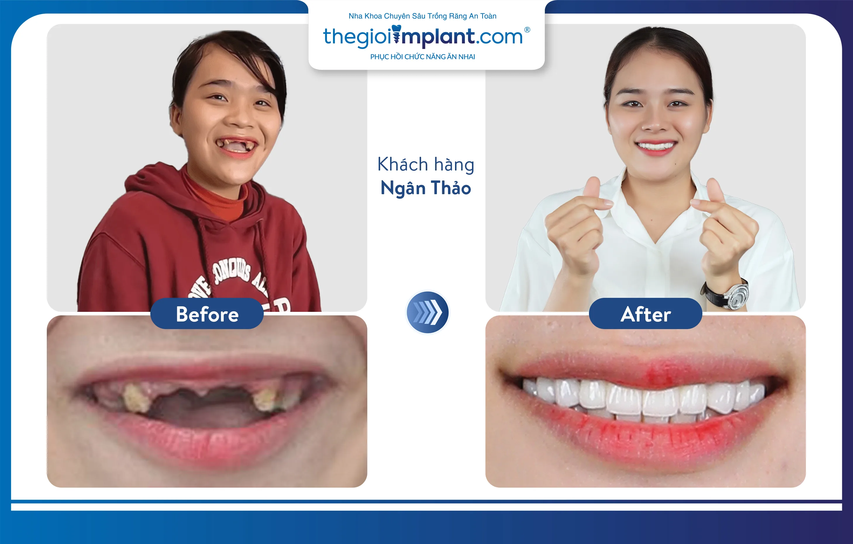 VTV1 ĐƯA TIN: NHA KHOA THẾ GIỚI IMPLANT.COM TRỒNG RĂNG AN TOÀN, BỀN VỮNG VỚI MÁNG ĐỊNH VỊ DSG