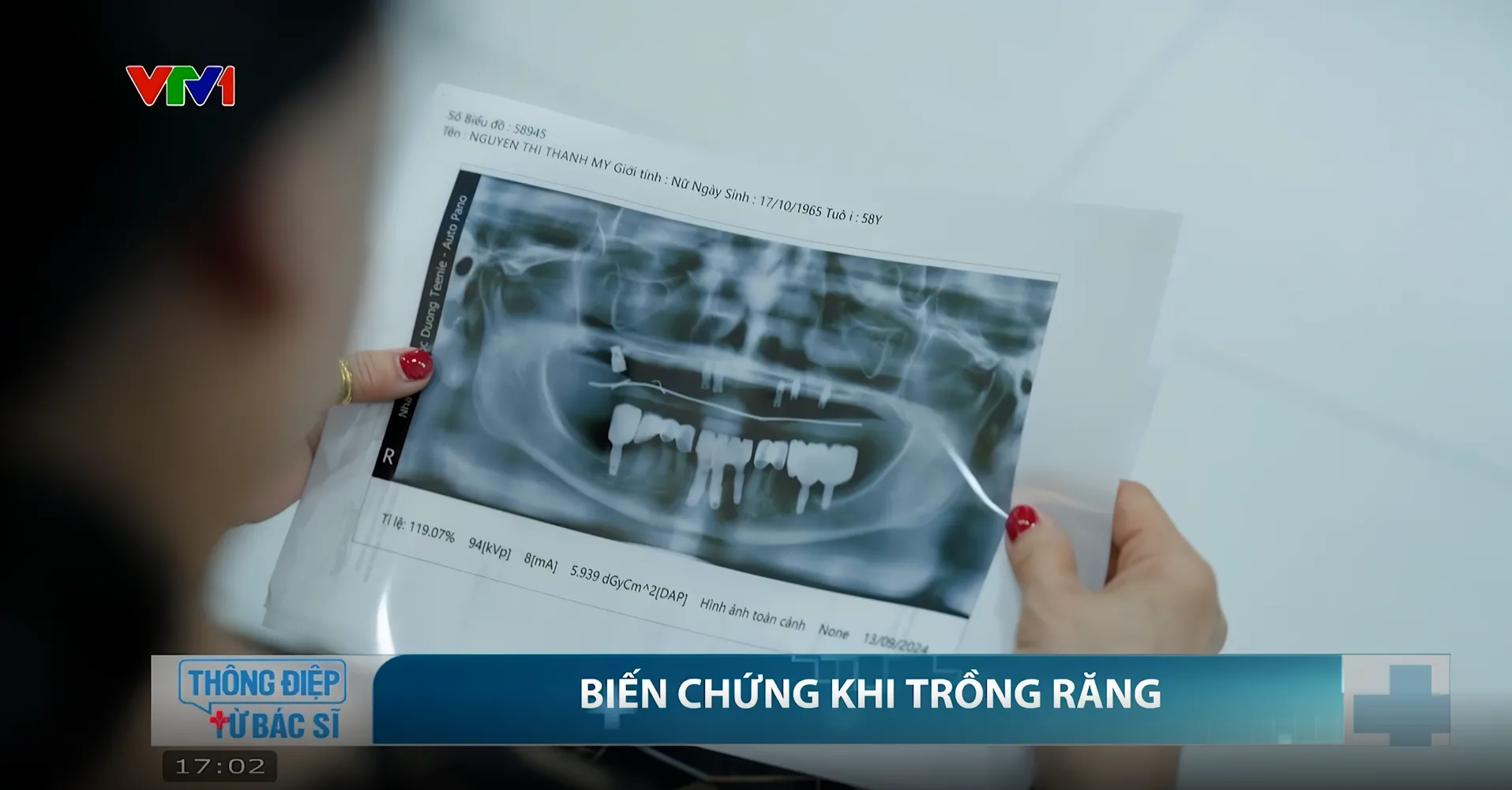 VTV1 ĐƯA TIN: NHA KHOA THẾ GIỚI IMPLANT.COM TRỒNG RĂNG AN TOÀN, BỀN VỮNG VỚI MÁNG ĐỊNH VỊ DSG