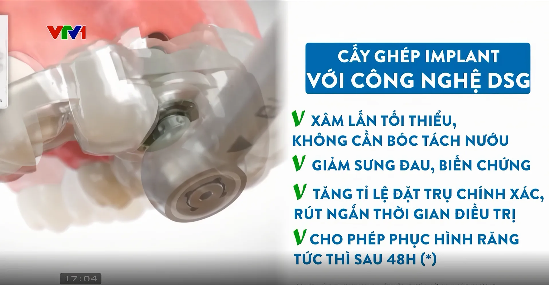 VTV1 ĐƯA TIN: NHA KHOA THẾ GIỚI IMPLANT.COM TRỒNG RĂNG AN TOÀN, BỀN VỮNG VỚI MÁNG ĐỊNH VỊ DSG