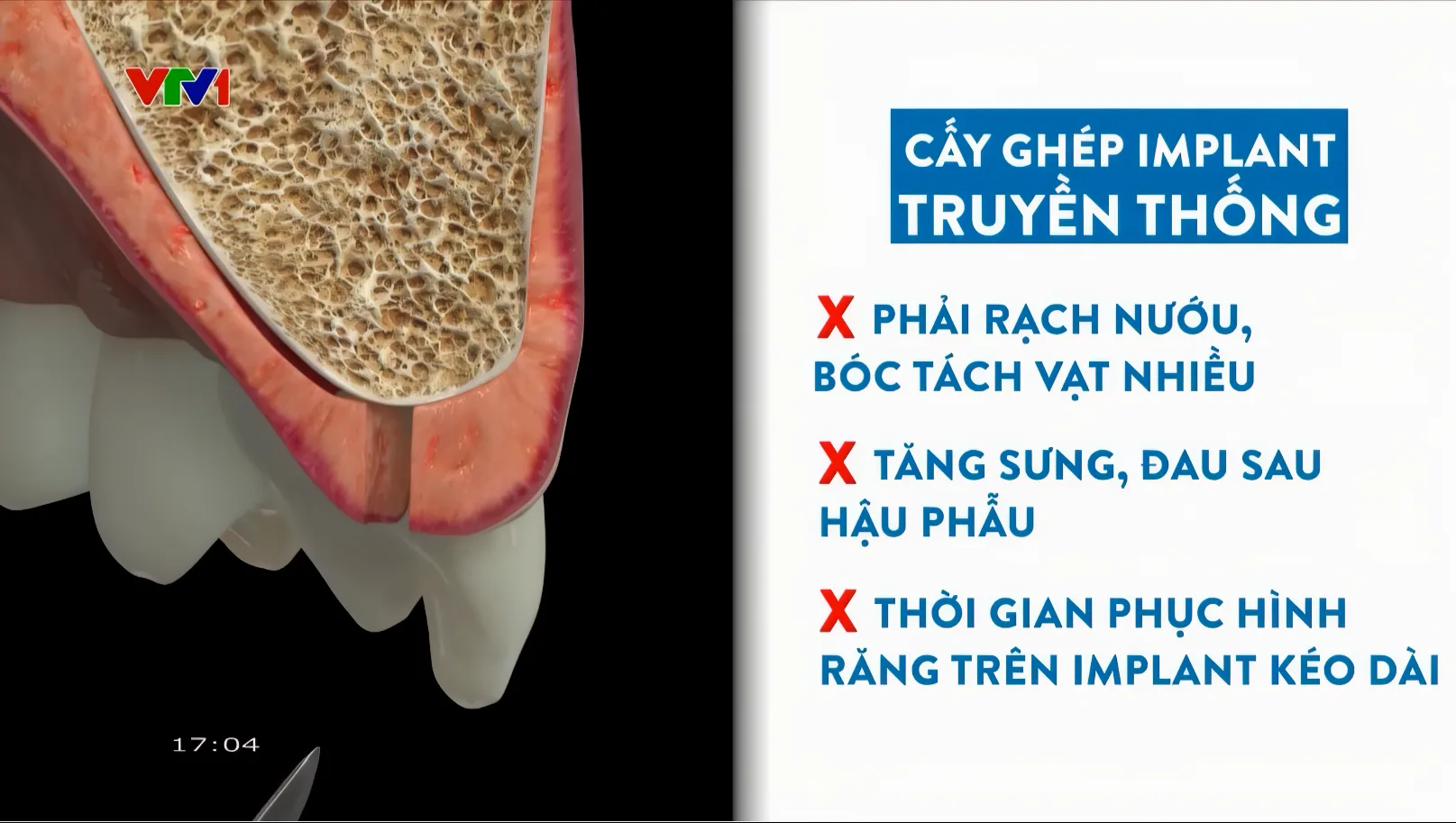 VTV1 ĐƯA TIN: NHA KHOA THẾ GIỚI IMPLANT.COM TRỒNG RĂNG AN TOÀN, BỀN VỮNG VỚI MÁNG ĐỊNH VỊ DSG